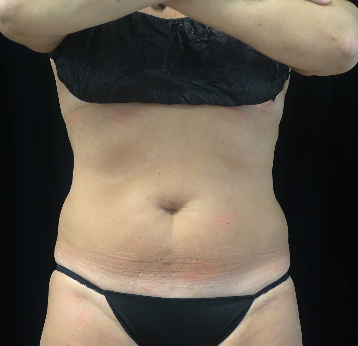 CoolSculpting Before & After Patient #17931