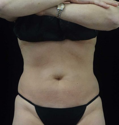 CoolSculpting Before & After Patient #17931