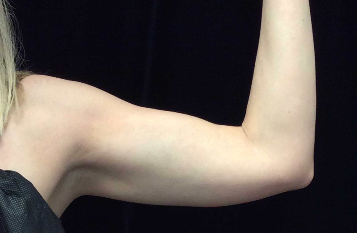 CoolSculpting Before & After Patient #17926