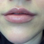 Lip Augmentation - Fillers Before & After Patient #17969