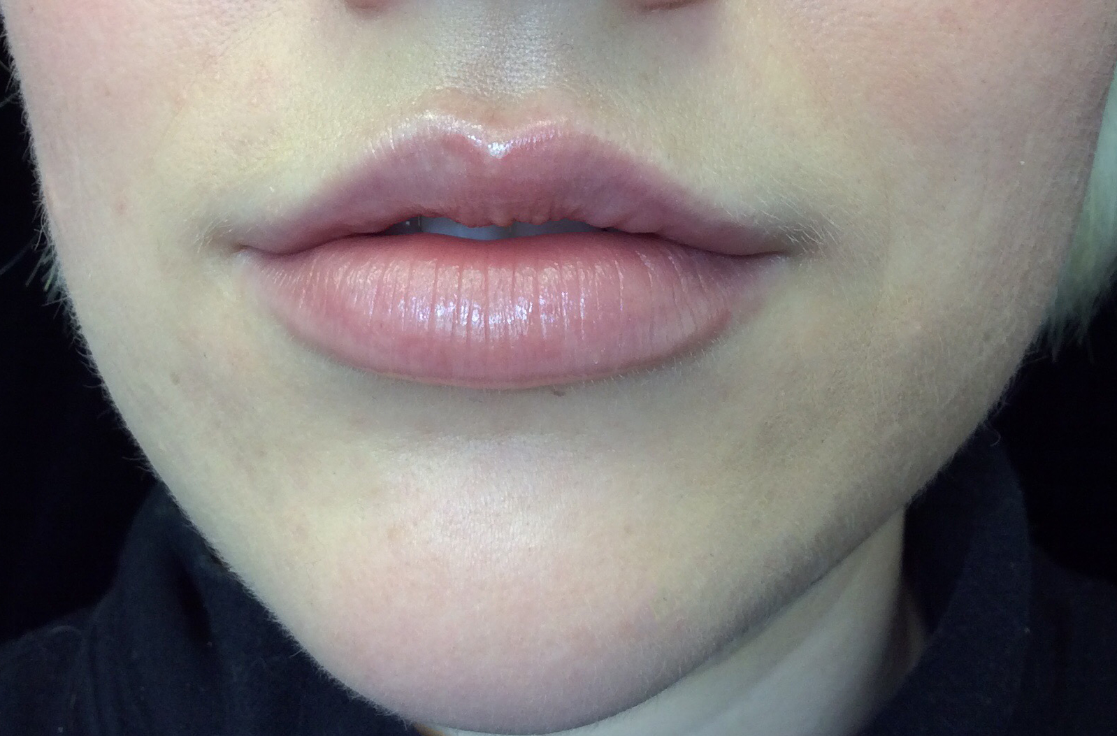 Lip Augmentation - Fillers Before & After Patient #17969