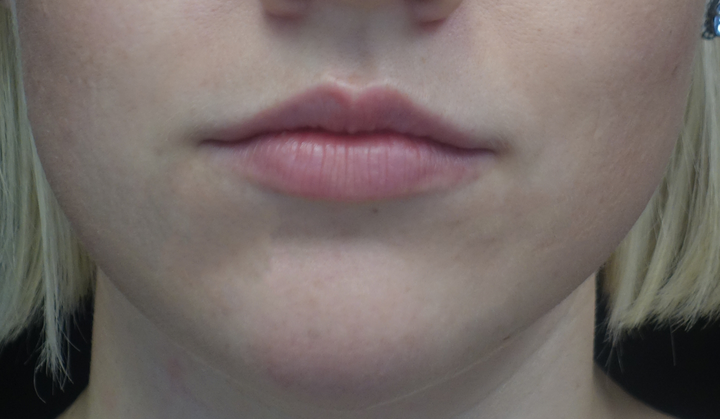 Lip Augmentation - Fillers Before & After Patient #17969