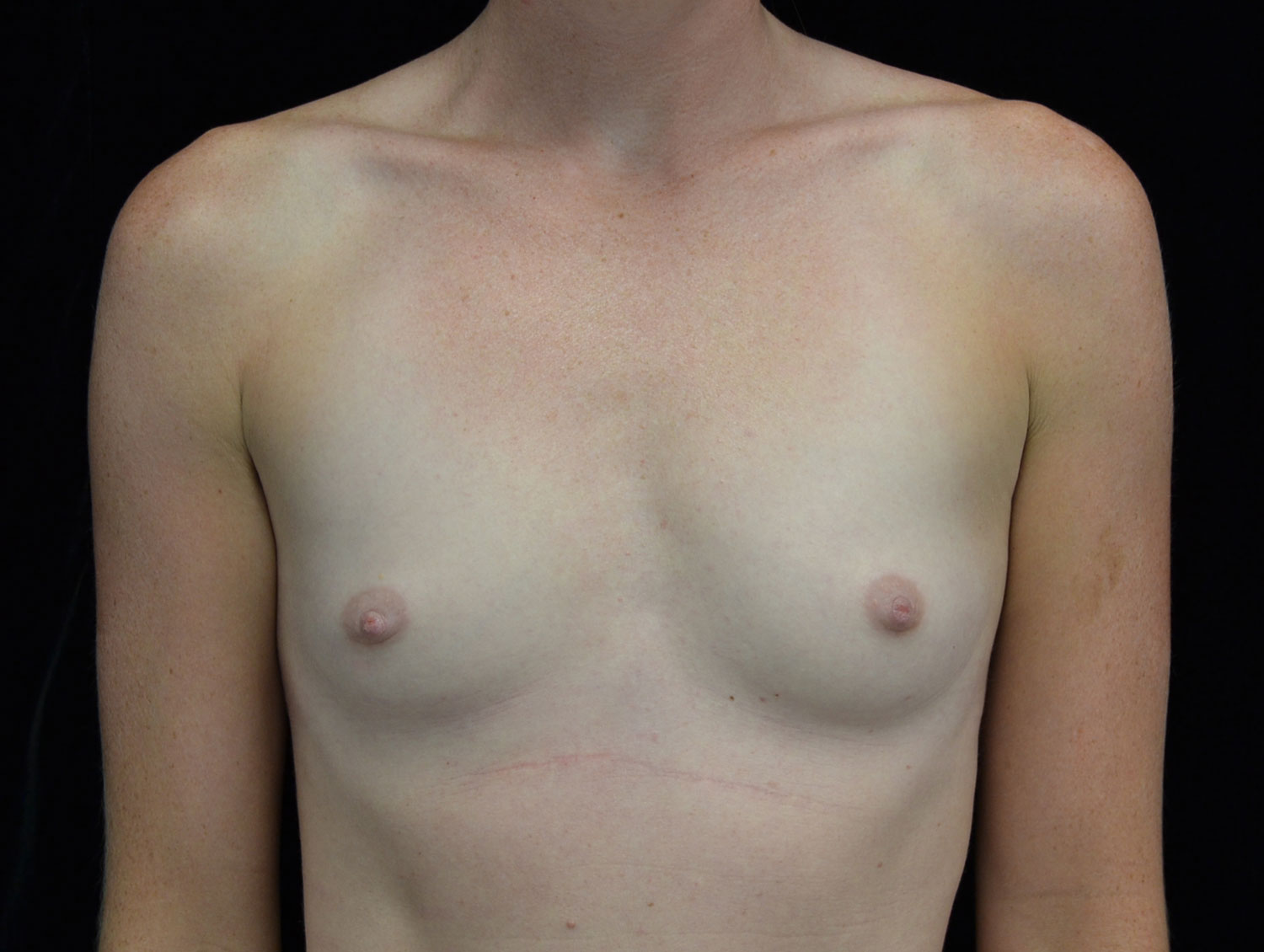 Breast Augmentation (Implants) Before & After Patient #18026