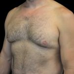 Gynecomastia Before & After Patient #18051
