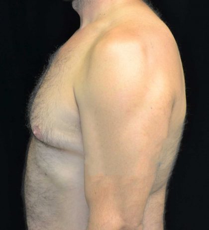 Gynecomastia Before & After Patient #18051