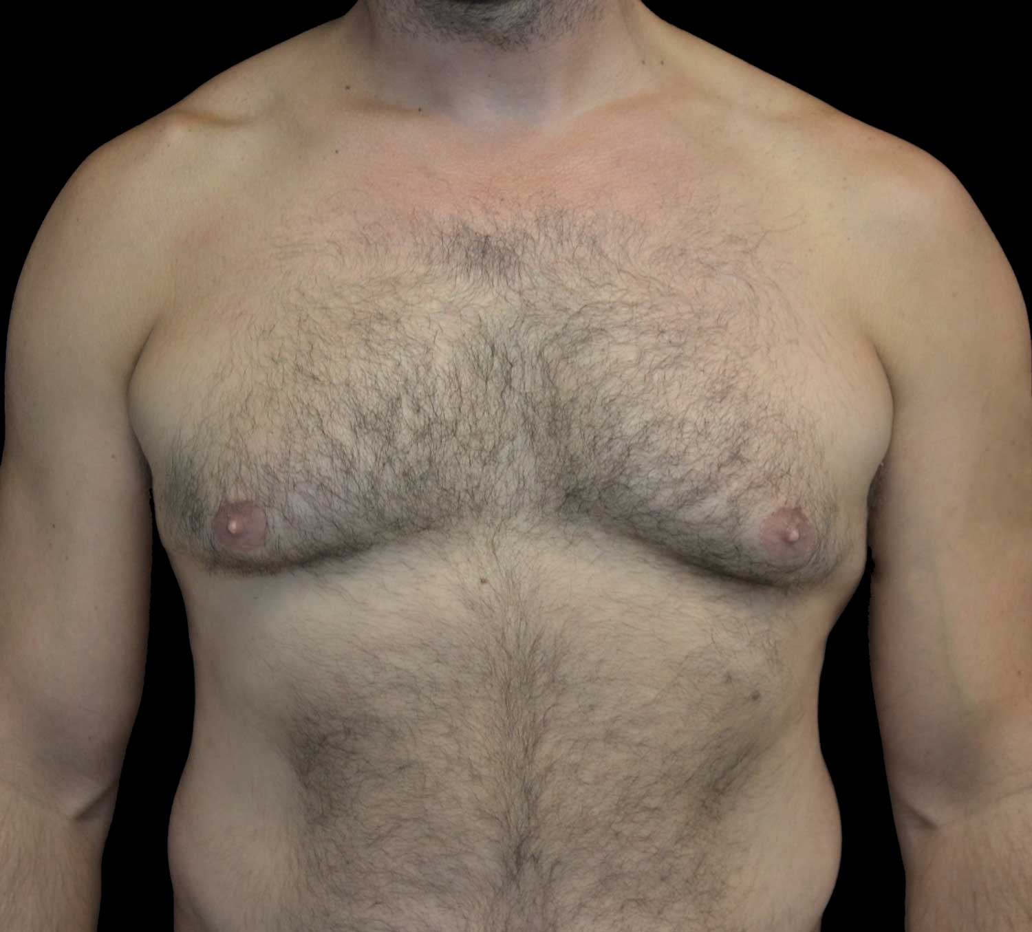 Gynecomastia Before & After Patient #18051