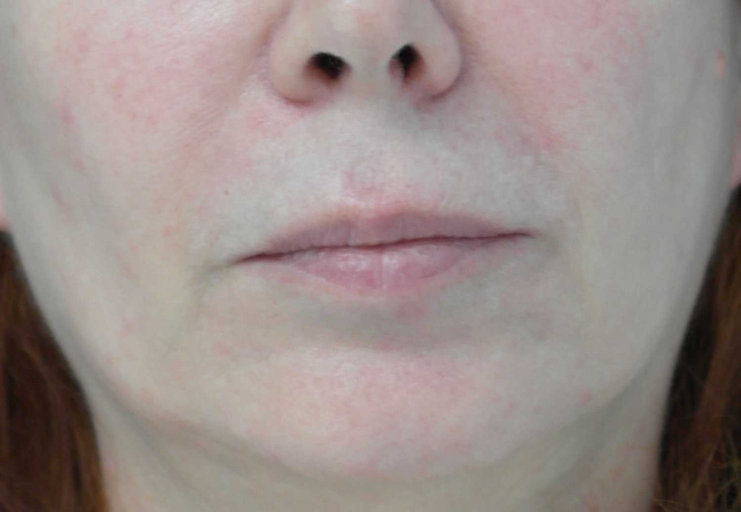 Fat Transfer to Face Before & After Patient #18048