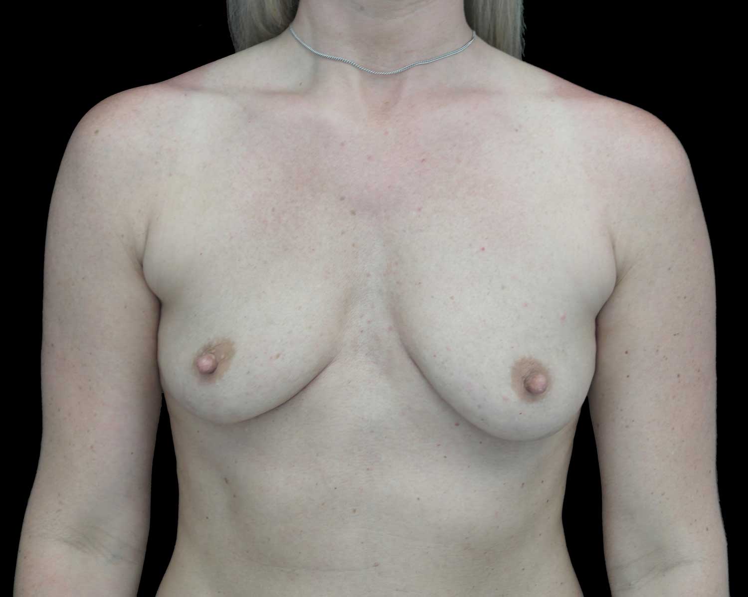 Breast Augmentation (Implants) Before & After Patient #18047