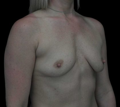 Breast Augmentation (Implants) Before & After Patient #18047