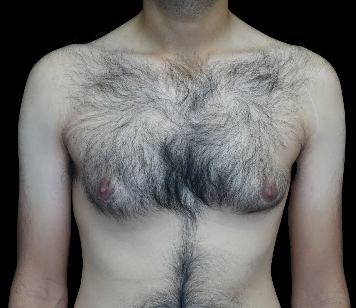 Gynecomastia Before & After Patient #18058
