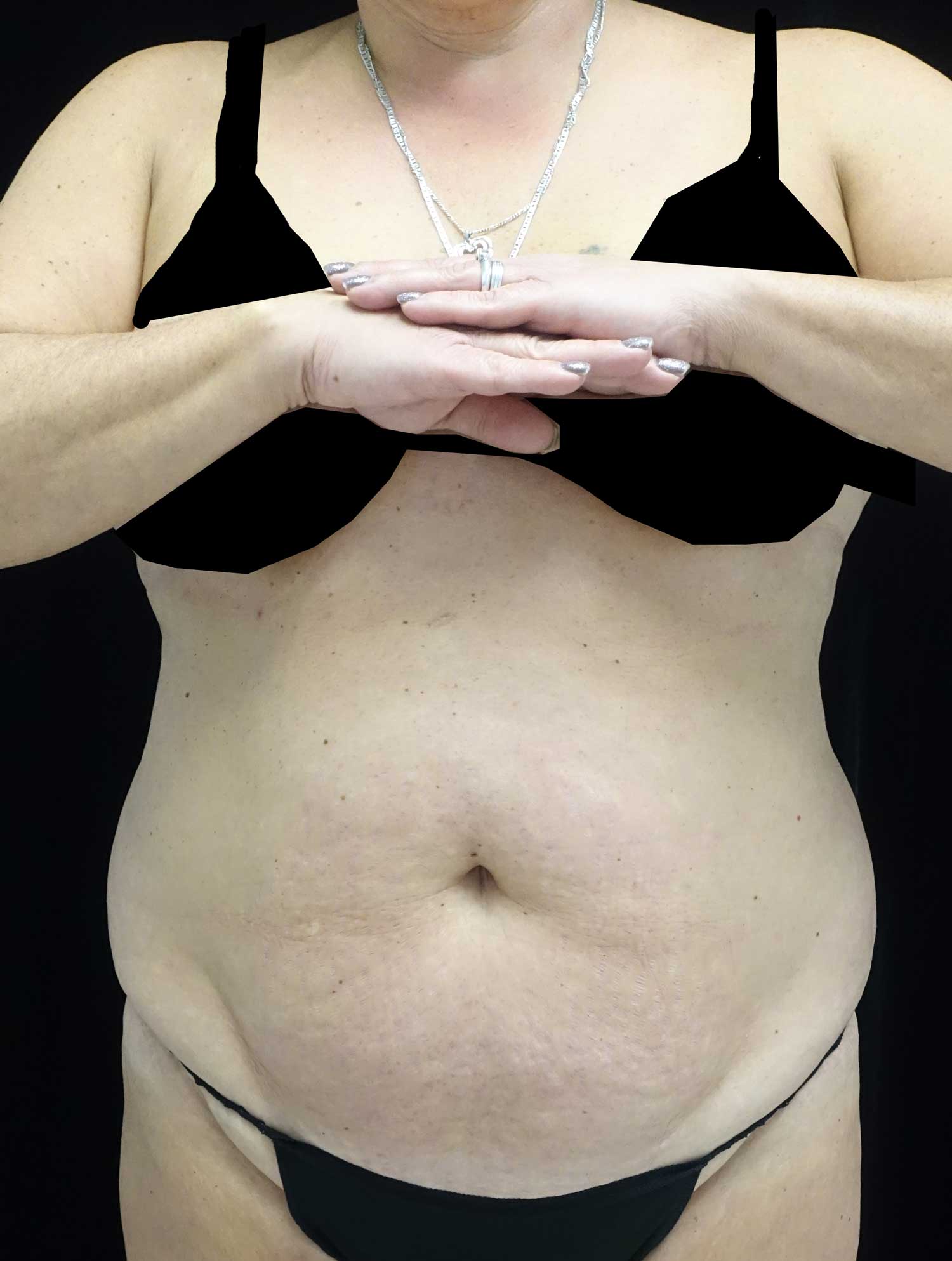 Lipoabdominoplasty Before & After Patient #18074