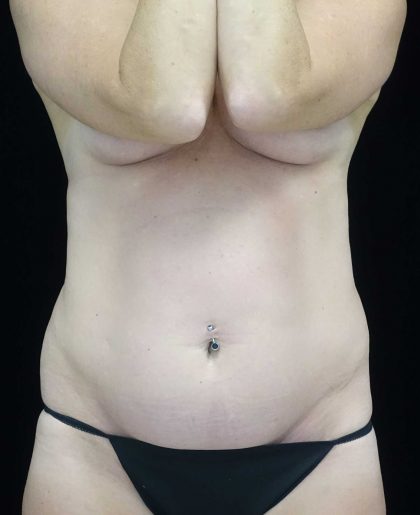 Tummy Tuck Before & After Patient #18081