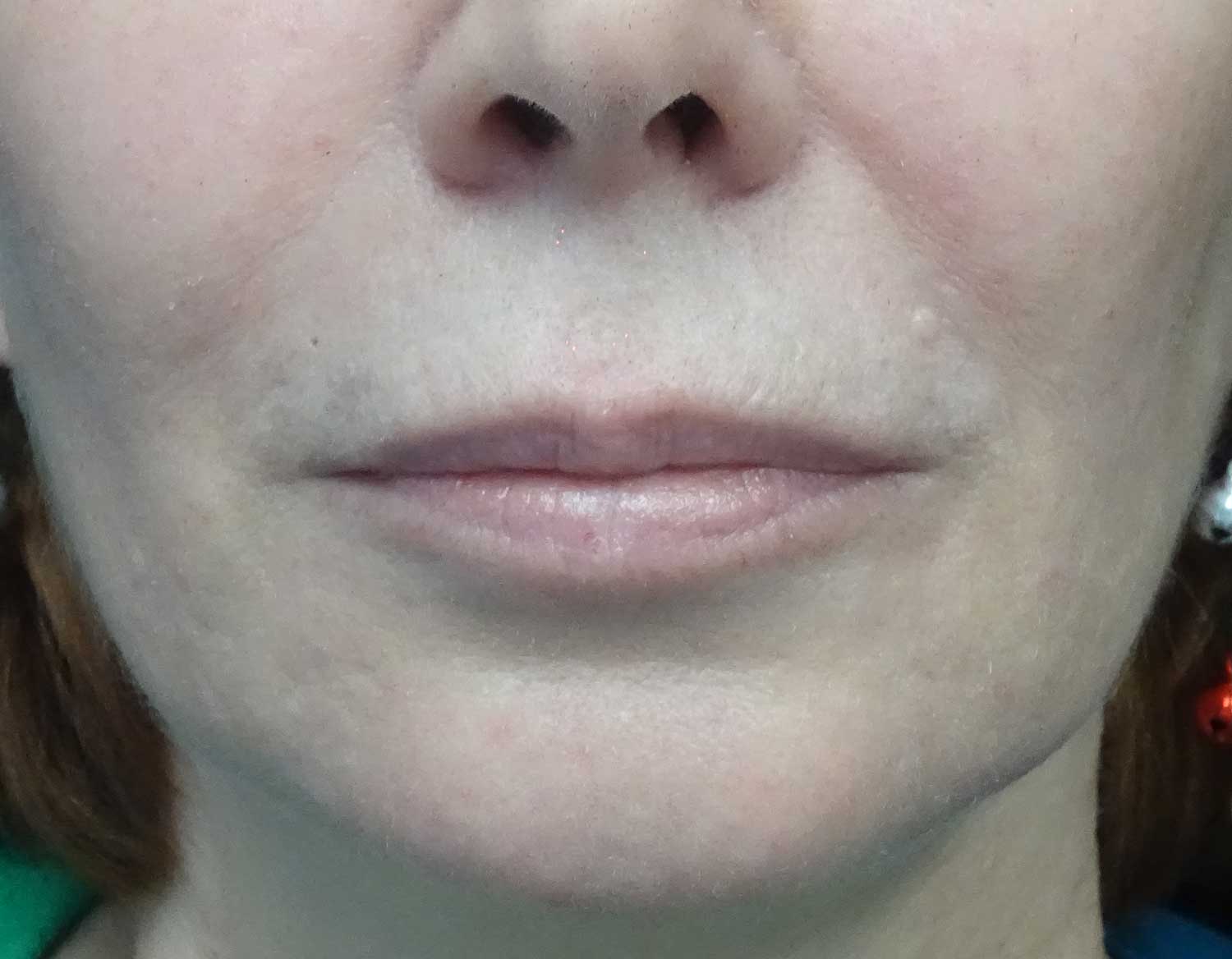 Fat Transfer to Face Before & After Patient #18048