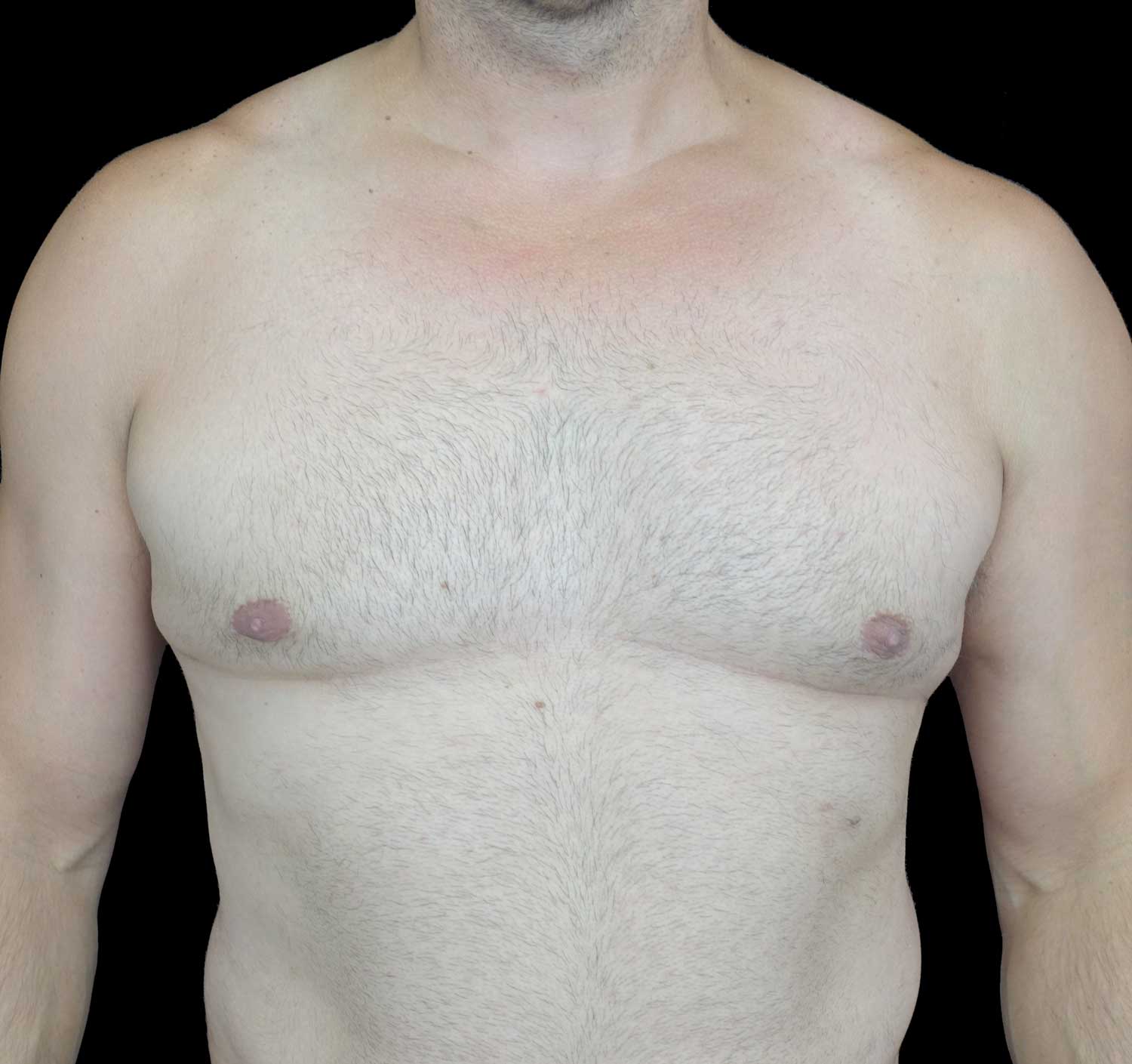 Gynecomastia Before & After Patient #18051