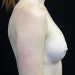 Breast Augmentation (Implants) Before & After Patient #18026