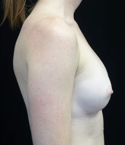 Breast Augmentation (Implants) Before & After Patient #18026