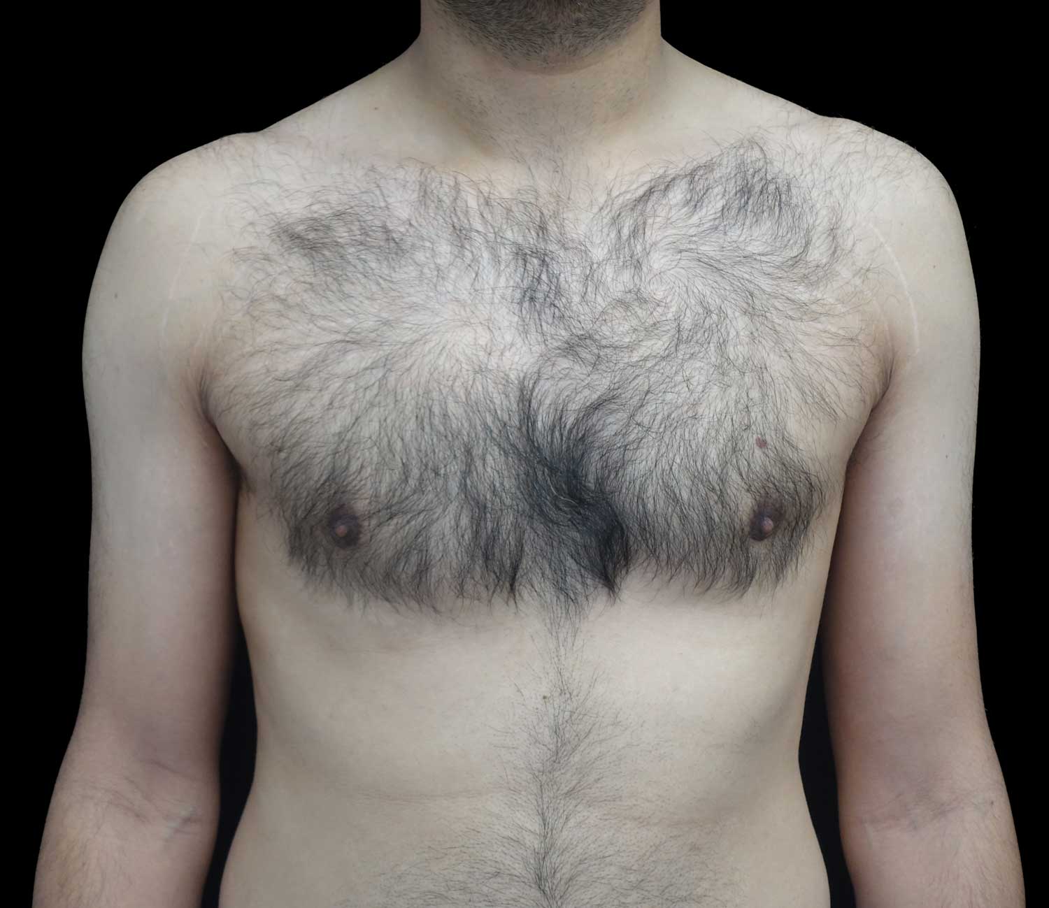 Gynecomastia Before & After Patient #18058