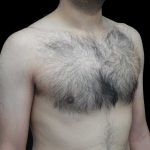 Gynecomastia Before & After Patient #18058