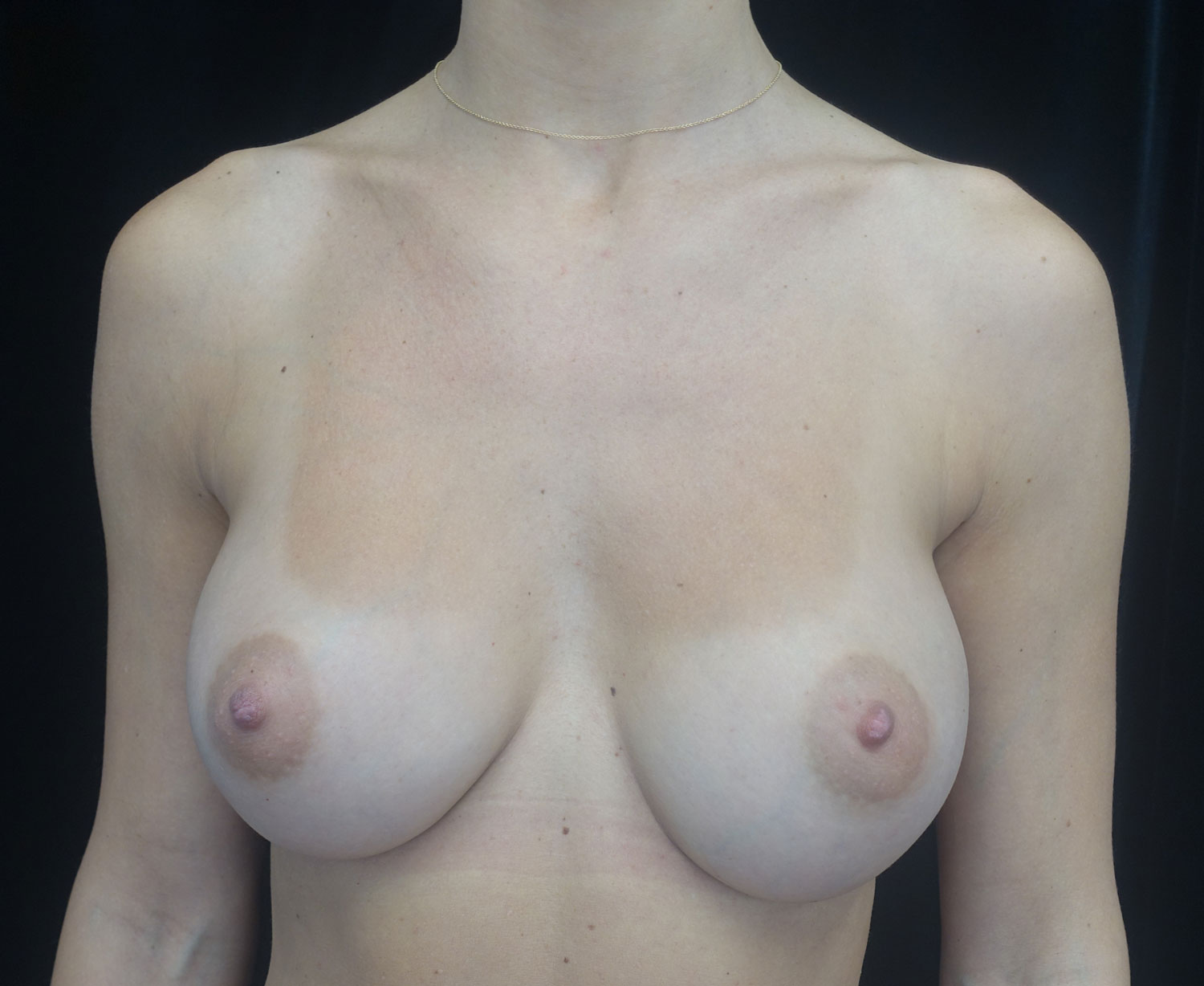 Breast Augmentation (Implants) Before & After Patient #18033