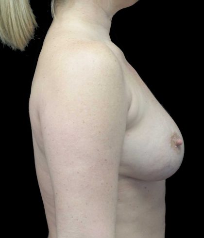 Breast Augmentation (Implants) Before & After Patient #18047