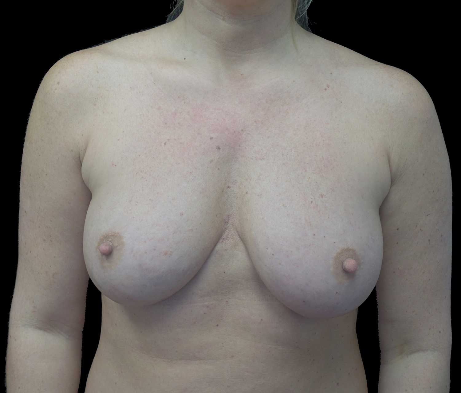 Breast Augmentation (Implants) Before & After Patient #18047