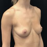 Breast Augmentation (Implants) Before & After Patient #18033