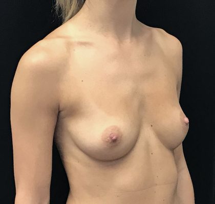 Breast Augmentation (Implants) Before & After Patient #18033
