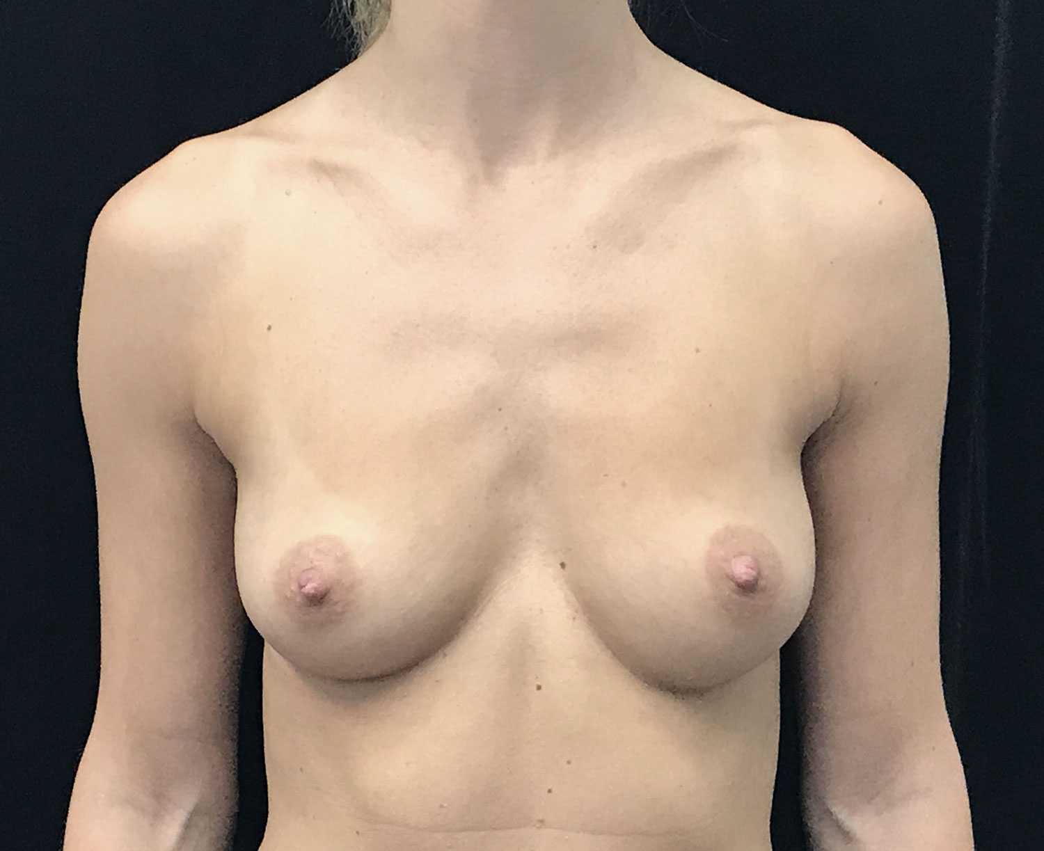 Breast Augmentation (Implants) Before & After Patient #18033