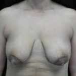 Breast Lift with Implants Before & After Patient #18385