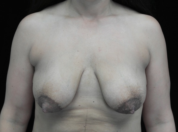 Breast Lift with Implants Before & After Patient #18385