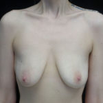 Breast Lift with Implants Before & After Patient #18350