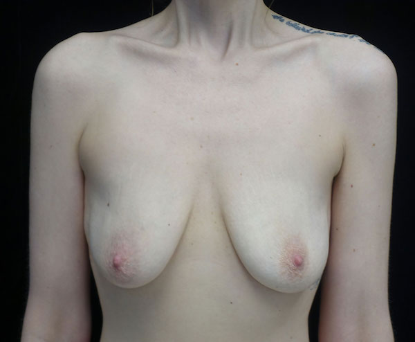 Breast Lift with Implants Before & After Patient #18350
