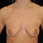 Breast Lift with Implants Before & After Patient #18357