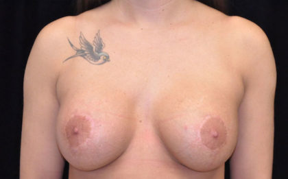 Breast Lift with Implants Before & After Patient #18357