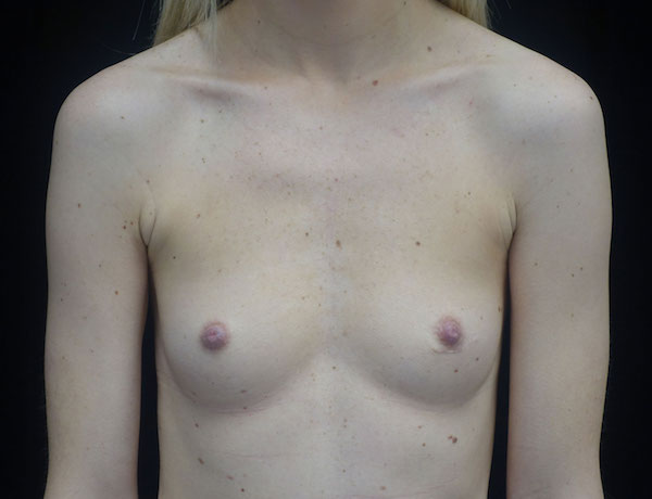 Breast Augmentation (Implants) Before & After Patient #18320