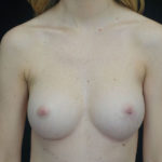 Breast Augmentation (Implants) Before & After Patient #18320