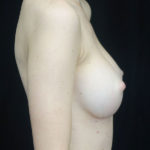 Breast Augmentation (Implants) Before & After Patient #18320
