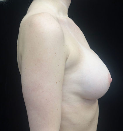 Breast Revision Before & After Patient #18364