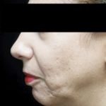 Chin Implants (Augmentation) Before & After Patient #18408