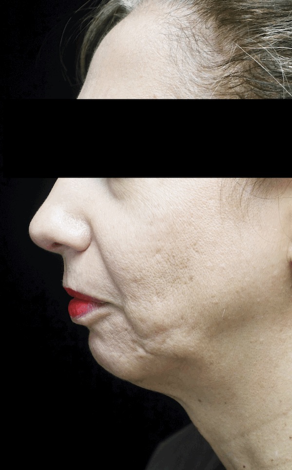 Chin Implants (Augmentation) Before & After Patient #18408