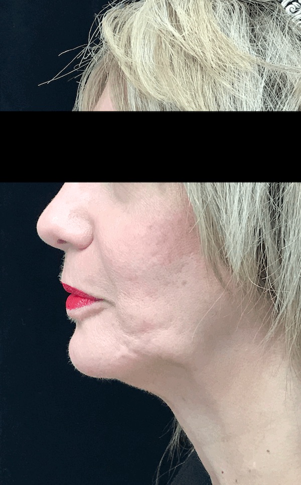Chin Implants (Augmentation) Before & After Patient #18408
