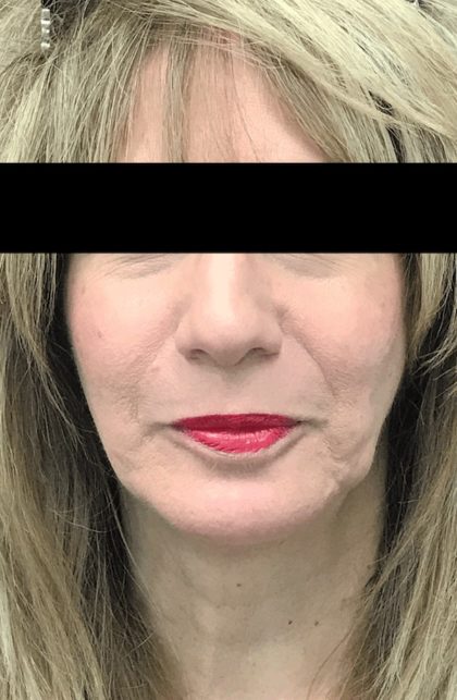 Chin Implants (Augmentation) Before & After Patient #18408
