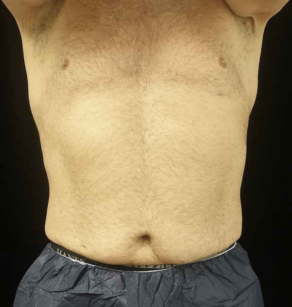 CoolSculpting Before & After Patient #18327