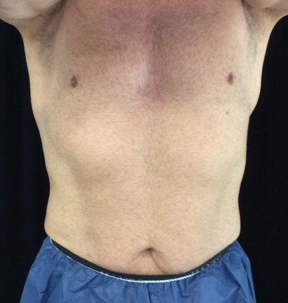 CoolSculpting Before & After Patient #18327