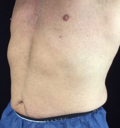 CoolSculpting Before & After Patient #18327
