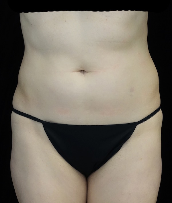 CoolSculpting Before & After Patient #18332