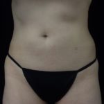 CoolSculpting Before & After Patient #18332