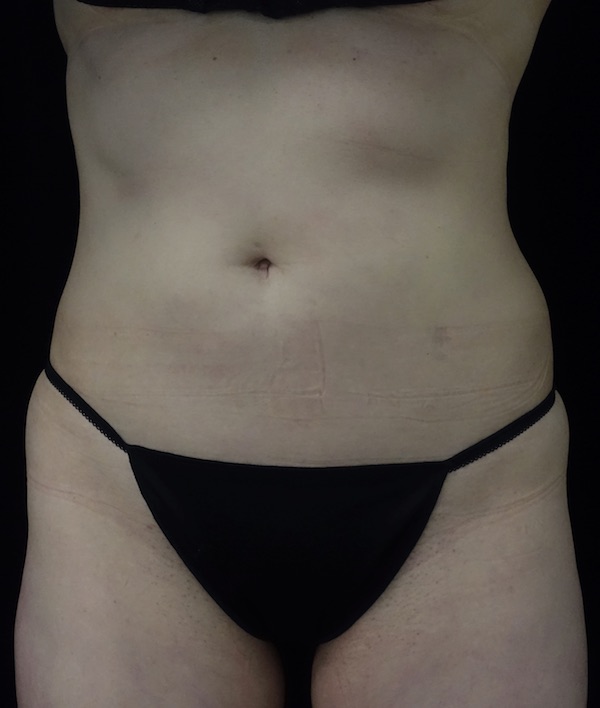 CoolSculpting Before & After Patient #18332