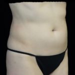 CoolSculpting Before & After Patient #18332