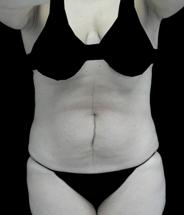 Tummy Tuck Before & After Patient #18378